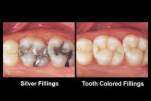 types of fillings